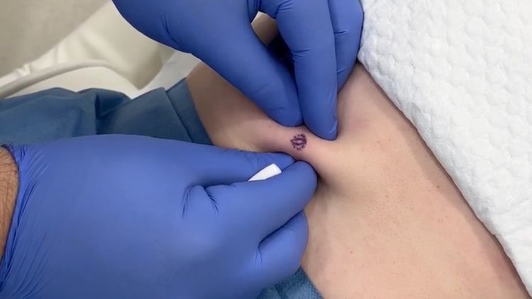 cyst removal london dr leah clinics