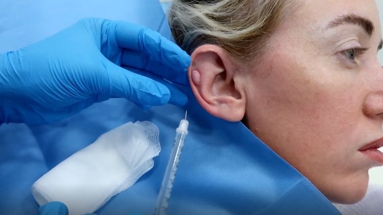 Keloid scar removal london dr leah clinics