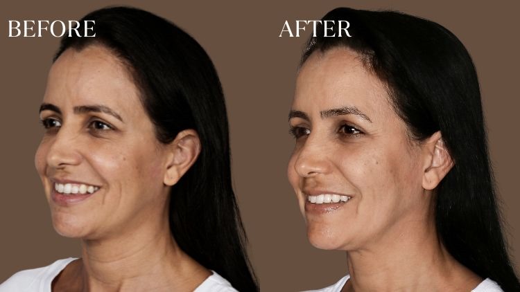 What is Sculptra?