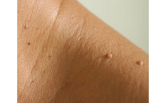 Skin tag removal london