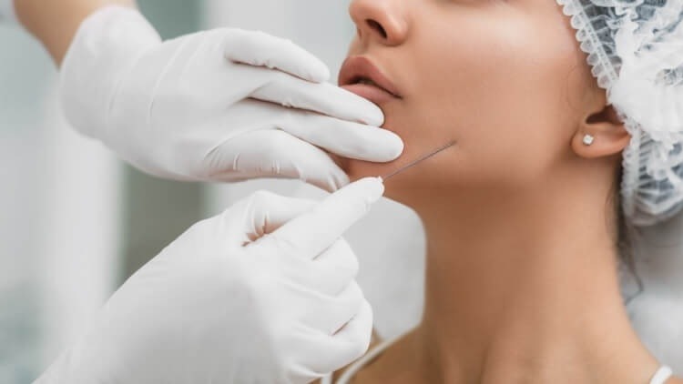 Jawline filler injection
