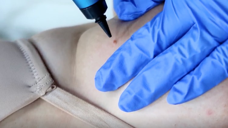 How does mole removal work?