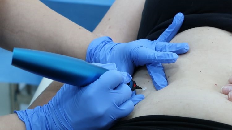 Cryopen Treatment Dr Leah Clinics London