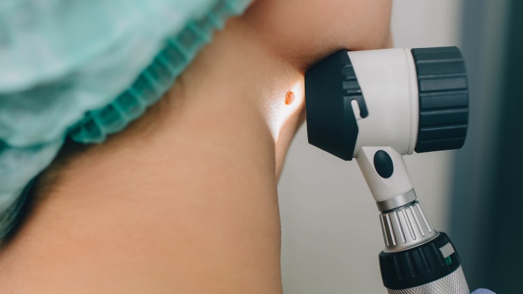 Mole checker london cancer mole screening dr leah clinics