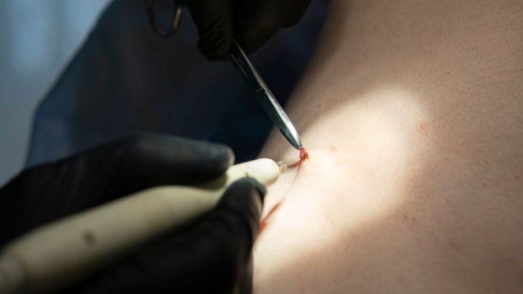 Wart Removal London