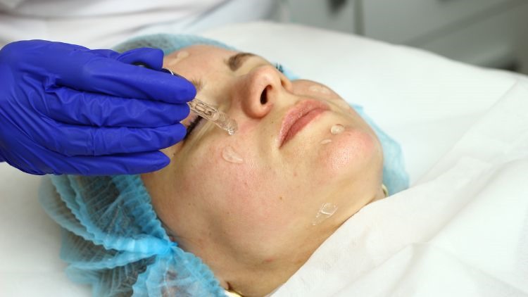 What is a Chemical skin peel? 